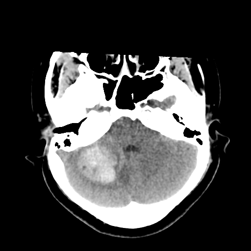 Cavernoma with hemorrhage (Radiopaedia 70755-80931 Axial non-contrast 14).png