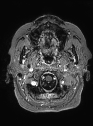 File:Cavernous hemangioma of the cerebellar falx (Radiopaedia 73025-83724 Axial T1 C+ 320).jpg