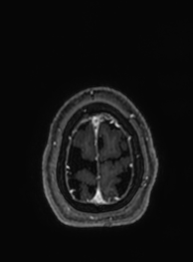 File:Cavernous hemangioma of the cerebellar falx (Radiopaedia 73025-83724 Axial T1 C+ 34).jpg