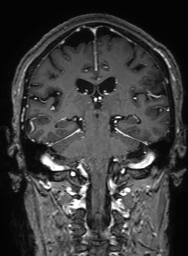 Cavernous hemangioma of the cerebellar falx (Radiopaedia 73025-83724 Coronal T1 C+ 226).jpg