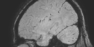 Cavernous hemangioma of the cerebellar falx (Radiopaedia 73025-83724 Sagittal BOLD 154).jpg