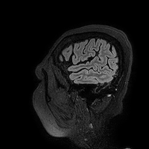 Cavernous hemangioma of the cerebellar falx (Radiopaedia 73025-83724 Sagittal FLAIR 198).jpg