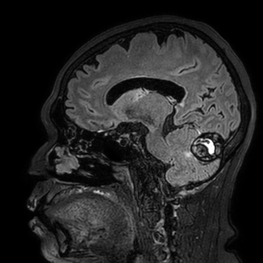 Cavernous hemangioma of the cerebellar falx (Radiopaedia 73025-83724 Sagittal FLAIR 87).jpg