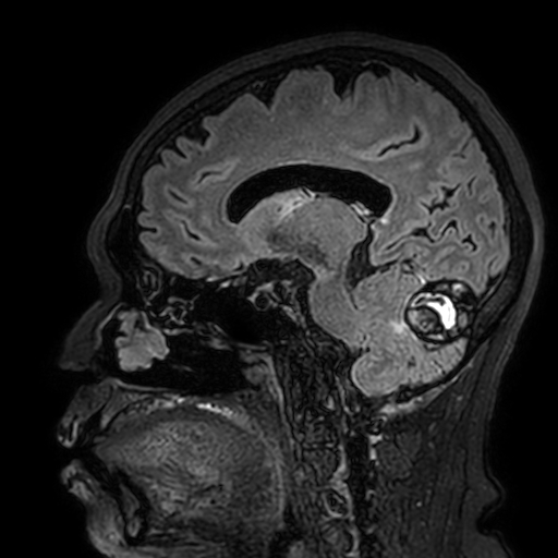 Cavernous hemangioma of the cerebellar falx (Radiopaedia 73025-83724 Sagittal FLAIR 88).jpg