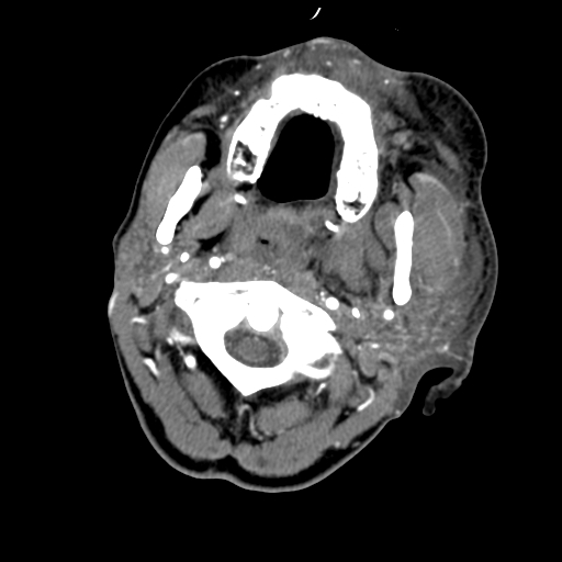 File:Cavernous sinus thrombosis (Radiopaedia 10619-11078 A 11).jpg