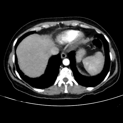 File:Cavitating lung mass - squamous cell carcinoma (Radiopaedia 48047-52854 B 38).png