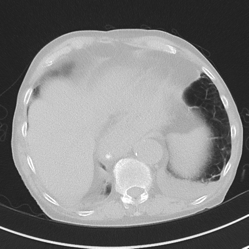 Cavitating pneumonia - lingular segments (Radiopaedia 34386-35678 Axial lung window 50).png