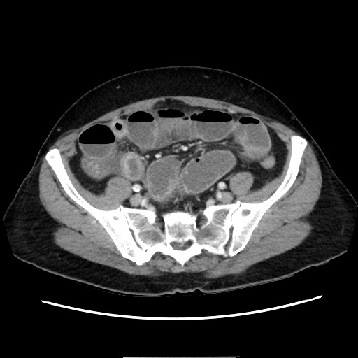 Cecal adenocarcinoma (Radiopaedia 75909-87331 A 67).jpg