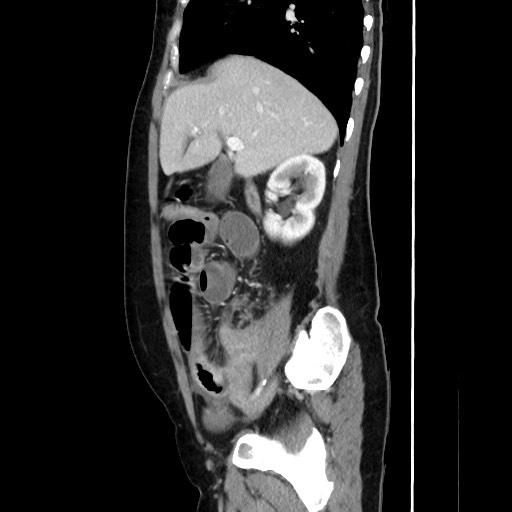 Cecal adenocarcinoma (Radiopaedia 75909-87331 C 27).jpg