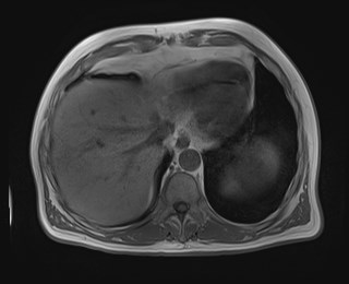 File:Cecal mass causing appendicitis (Radiopaedia 59207-66532 Axial T1 in-phase 25).jpg