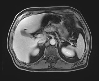 Cecal mass causing appendicitis (Radiopaedia 59207-66532 J 43).jpg