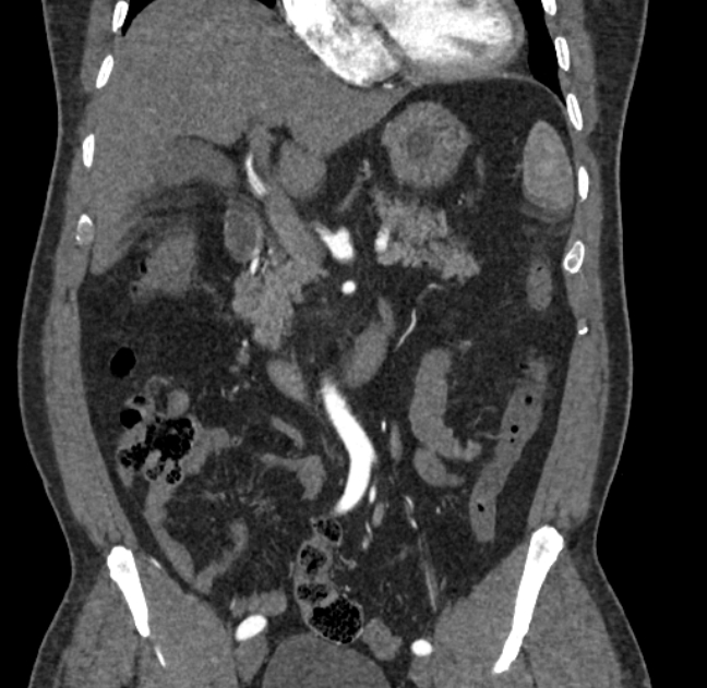 Celiac artery dissection (Radiopaedia 52194-58080 C 40).jpg