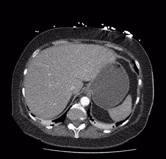 Celiac artery severe stenosis and dissection (Radiopaedia 44128-47842 B 11).jpg