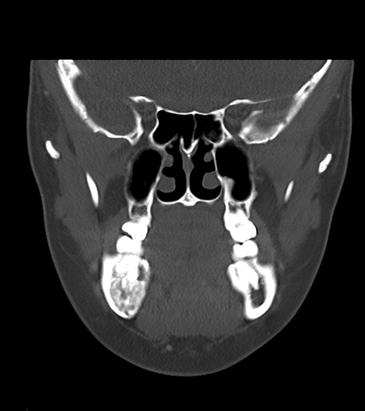 Cemento-ossifying fibroma (Radiopaedia 46243-50643 Coronal bone window 26).png
