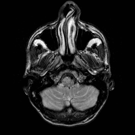 File:Central-variant posterior reversible encephalopathy syndrome (PRES) (Radiopaedia 43880-47358 Axial T2 2).jpg