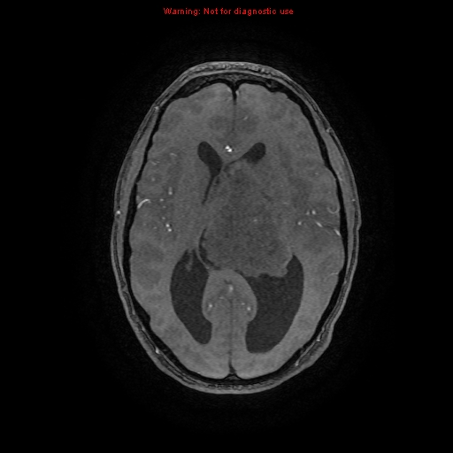 Central neurocytoma (Radiopaedia 13188-13206 Axial MRA 34).jpg