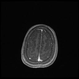 Central neurocytoma (Radiopaedia 30220-30842 Axial T1 C+ 131).jpg