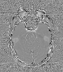 File:Central neurocytoma (Radiopaedia 84497-99872 Axial 25).jpg