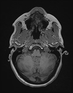 Central neurocytoma (Radiopaedia 84497-99872 Axial T1 47).jpg