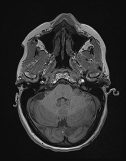 Central neurocytoma (Radiopaedia 84497-99872 Axial T1 51).jpg