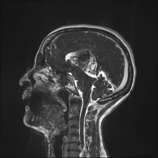 Central neurocytoma (Radiopaedia 84497-99872 Sagittal CISS 45).jpg