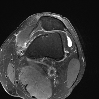File:Central osteophyte (Radiopaedia 72592-83151 Axial PD fat sat 4).jpg