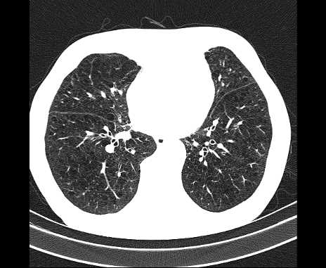 Centrilobular pulmonary emphysema (Radiopaedia 62468-70718 Axial lung window 50).jpg