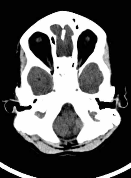 Cerebellar abscess (Radiopaedia 73727-84527 Axial non-contrast 24).jpg