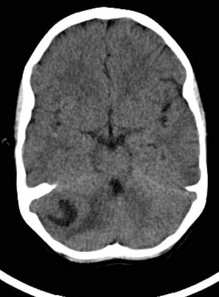 Cerebellar abscess (Radiopaedia 73727-84527 Axial non-contrast 32).jpg