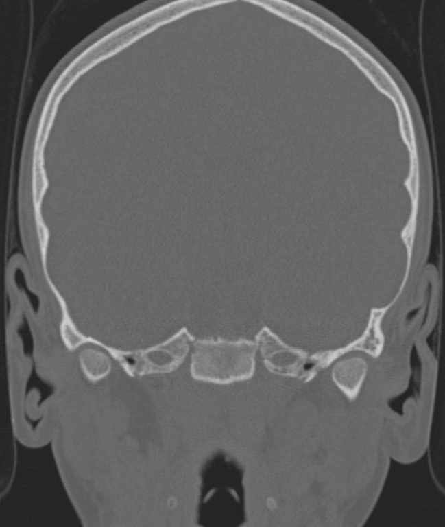 Cerebellar abscess (Radiopaedia 73727-84527 Coronal bone window 87).jpg