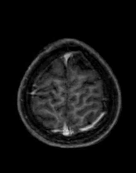 Cerebellar abscess (Radiopaedia 73727-84563 Axial T1 C+ fat sat 95).jpg