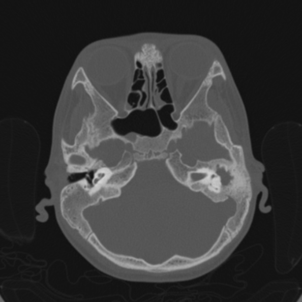 Cerebellar abscess secondary to mastoiditis (Radiopaedia 26284-26413 Axial bone window 52).jpg