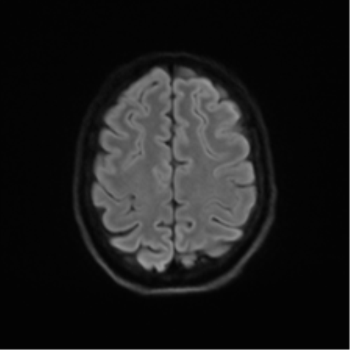 Cerebellar agenesis with hypoplastic pons (pontocerebellar hypoplasia) (Radiopaedia 57224-64138 Axial DWI 66).png