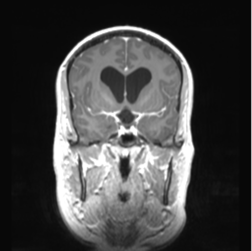 Cerebellar ependymoma complicated by post-operative subdural hematoma (Radiopaedia 83322-97736 Coronal T1 C+ 22).png