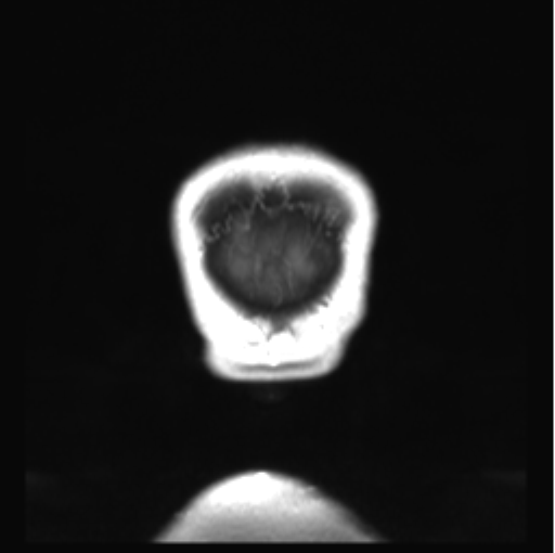 Cerebellar ependymoma complicated by post-operative subdural hematoma (Radiopaedia 83322-97736 Coronal T1 C+ 58).png