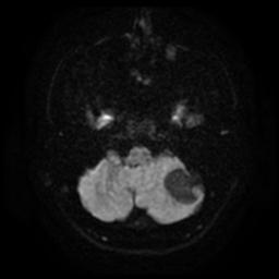 Cerebellar hemangioblastoma (Radiopaedia 29570-30077 Axial DWI 6).jpg