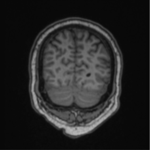 Cerebellar hemangioblastomas and pituitary adenoma (Radiopaedia 85490-101176 Coronal T1 22).png