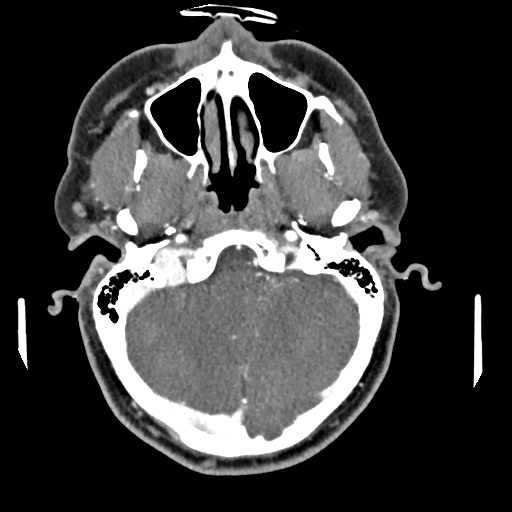 Cerebellar infarct due to vertebral artery dissection with posterior fossa decompression (Radiopaedia 82779-97029 C 29).png