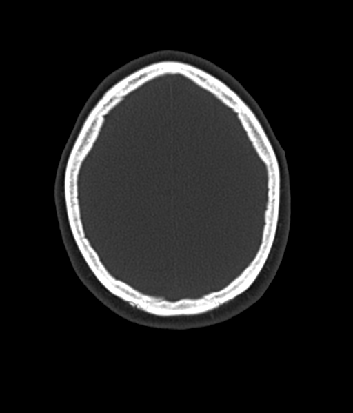 Cerebellar metastases - colorectal adenocarcinoma (Radiopaedia 40947-43652 AX Bone C- 2.0 MPR 52).png