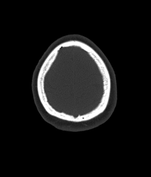 Cerebellar metastases - colorectal adenocarcinoma (Radiopaedia 40947-43652 AX Bone C- 2.0 MPR 59).png