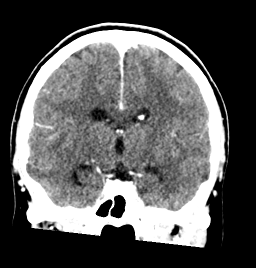 Cerebellar metastases - colorectal adenocarcinoma (Radiopaedia 40947-43652 Coronal C+ 49).png