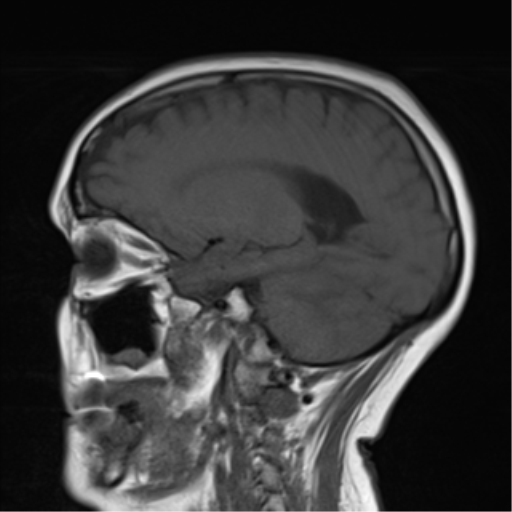 File:Cerebellar metastasis (Radiopaedia 54578-60810 Sagittal T1 14).png