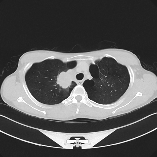 Cerebellar metastasis - adenocarcinoma lung (Radiopaedia 63184-71717 Axial lung window 18).png