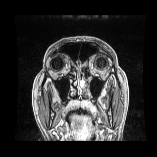 Cerebellar metastasis of pulmonary adenocarcinoma, cavernous venous malformation, and developmental venous anomaly (Radiopaedia 85827-101661 Coronal T1 C+ 83).jpg