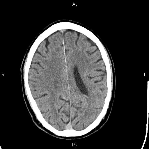 Cerebellopontine angle arachnoid cyst (Radiopaedia 85149-100704 Axial With contrast 33).jpg