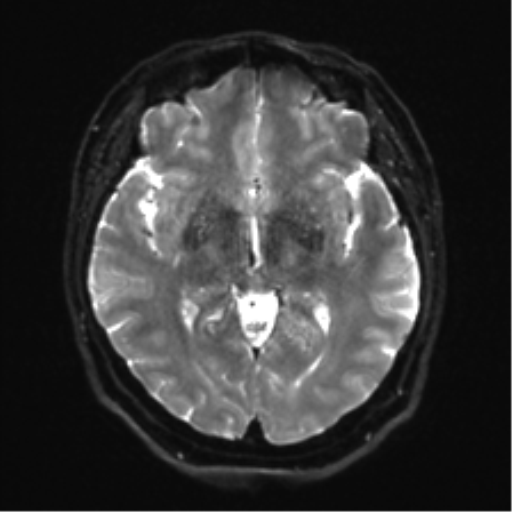 Cerebellopontine angle meningioma (Radiopaedia 48434-53348 Axial DWI 18).png