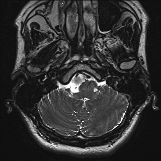 Cerebellopontine angle meningioma (Radiopaedia 72983-83680 Axial FIESTA 7).jpg