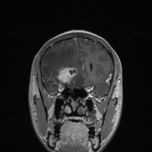 Cerebral abscess (Radiopaedia 24212-24478 Coronal T1 C+ 73).jpg