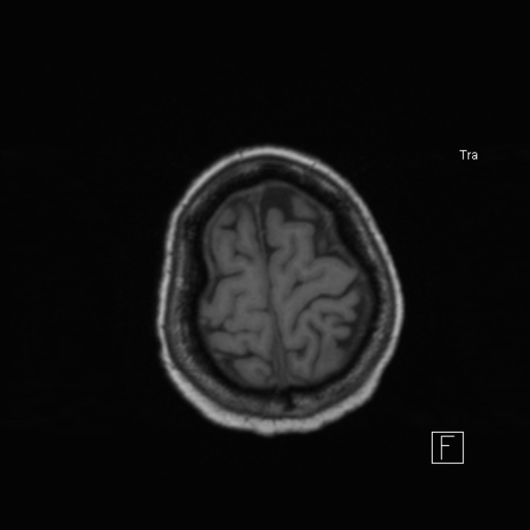 Cerebral abscess (Radiopaedia 26111-26247 Axial T1 48).jpg