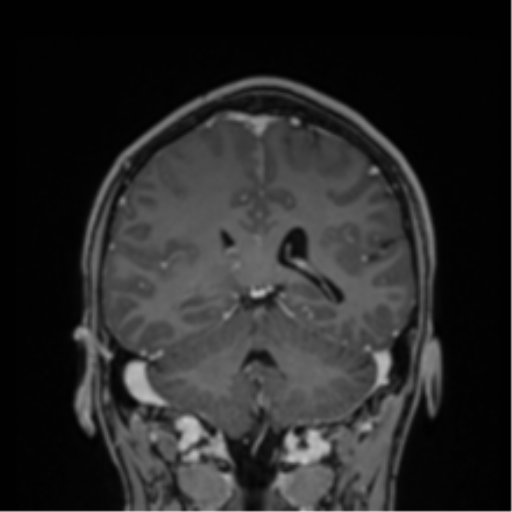 File:Cerebral abscess (Radiopaedia 60342-68009 H 16).png